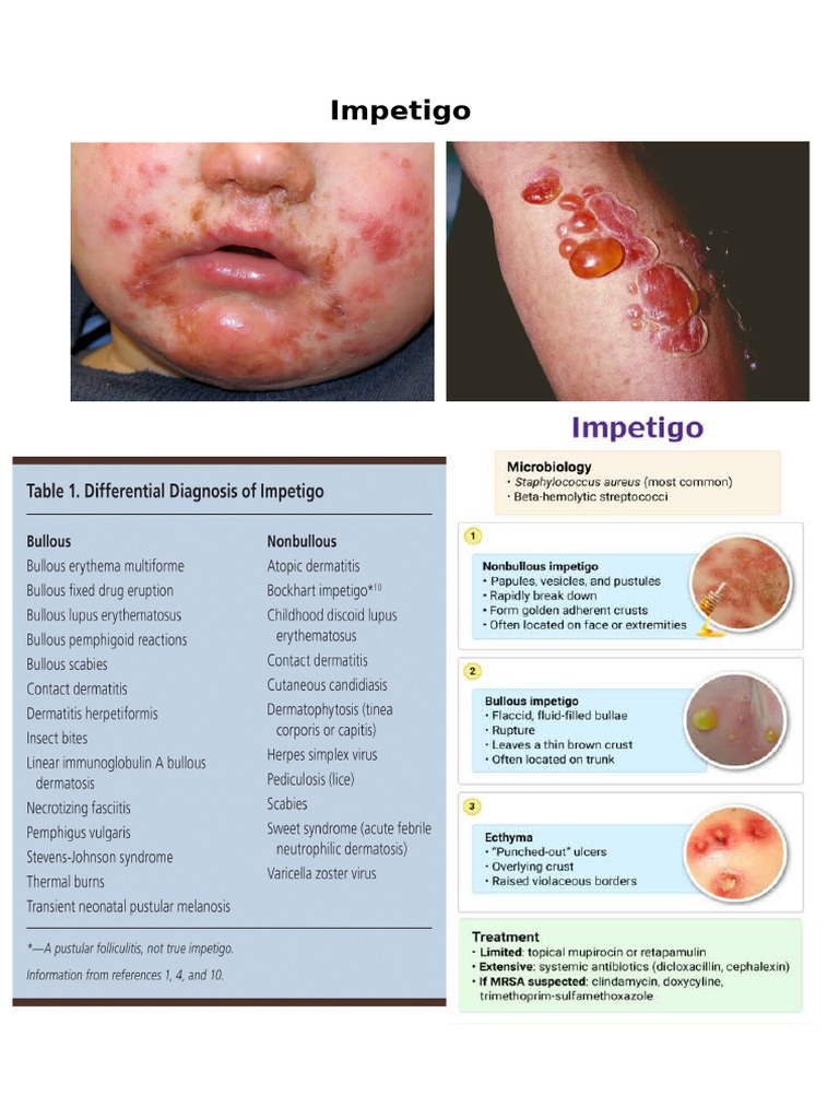 Impetigo Treatment Options and Causes | PDF