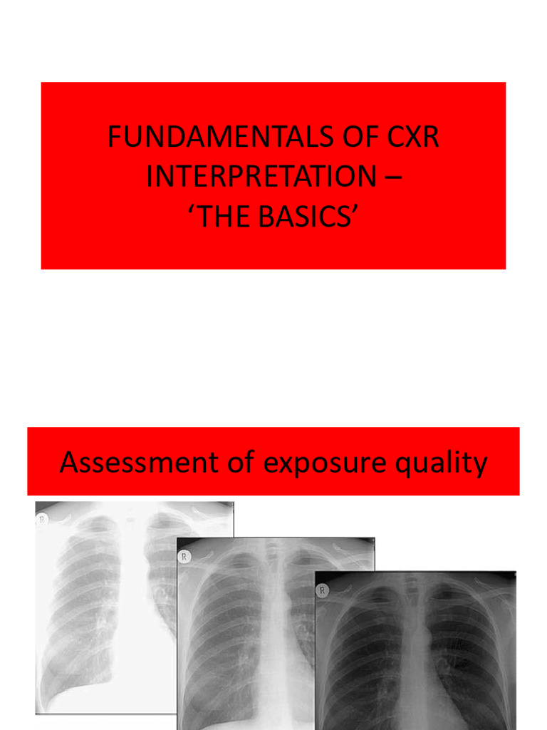 CXR Interpretation Basics Guide | PDF