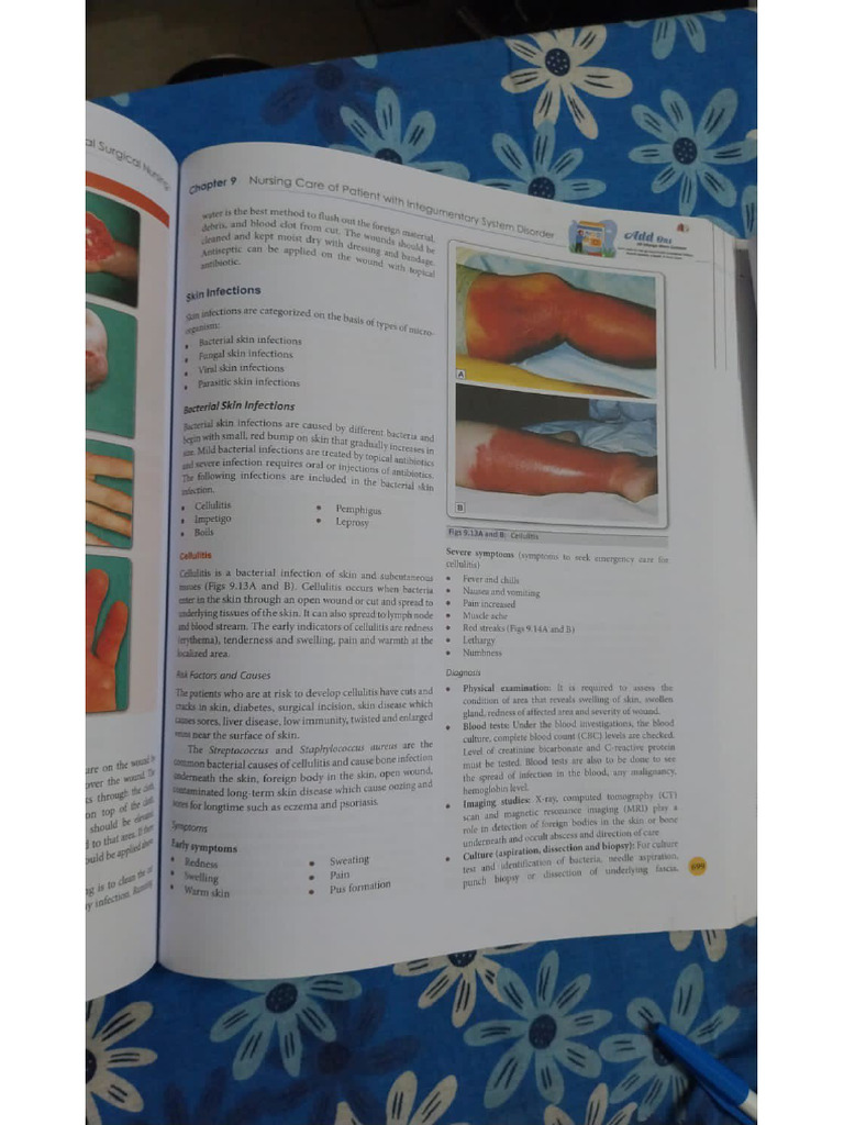 Cellulitis | PDF