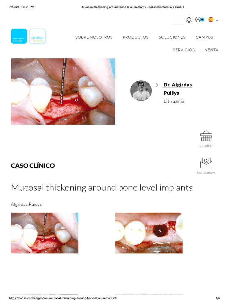 Mucosal Thickening in Bone Implants | PDF | Dental Implant | Anatomy