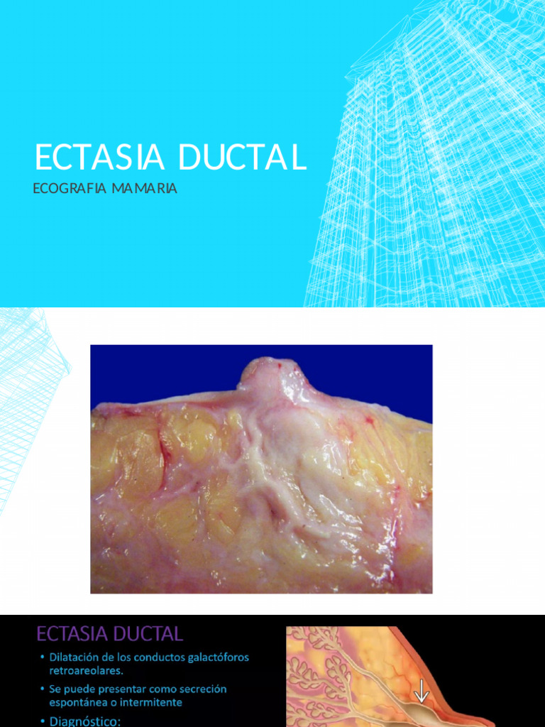 Ecografía de Ectasia Ductal | PDF | Pecho | Características sexuales ...
