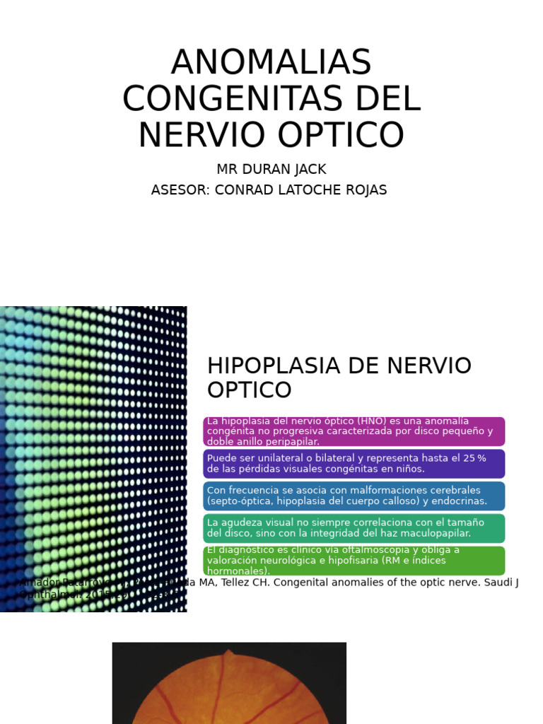 Anomalias Congenitas Del Nervio Optico | PDF | Glaucoma | Enfermedades ...