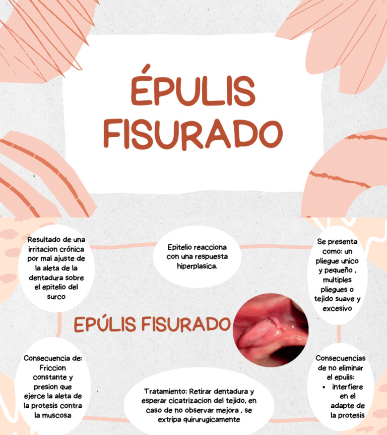 Épulis Fisurado | PDF
