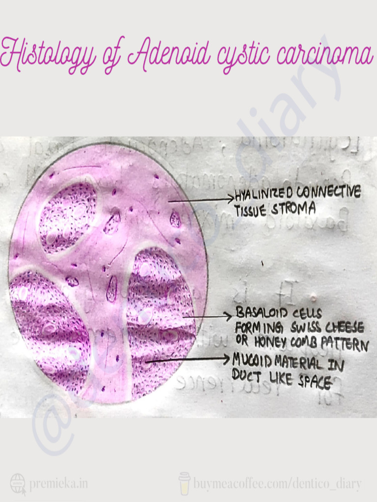 Histology of Adenoid Cystic Carcinoma | PDF