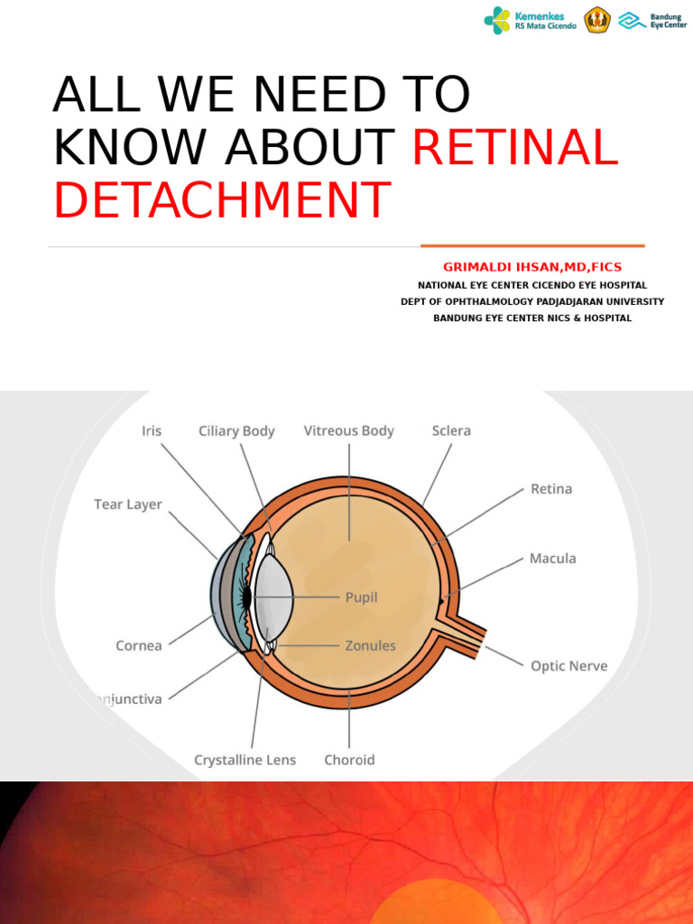 All We Need To Know About: Retinal Detachment | PDF