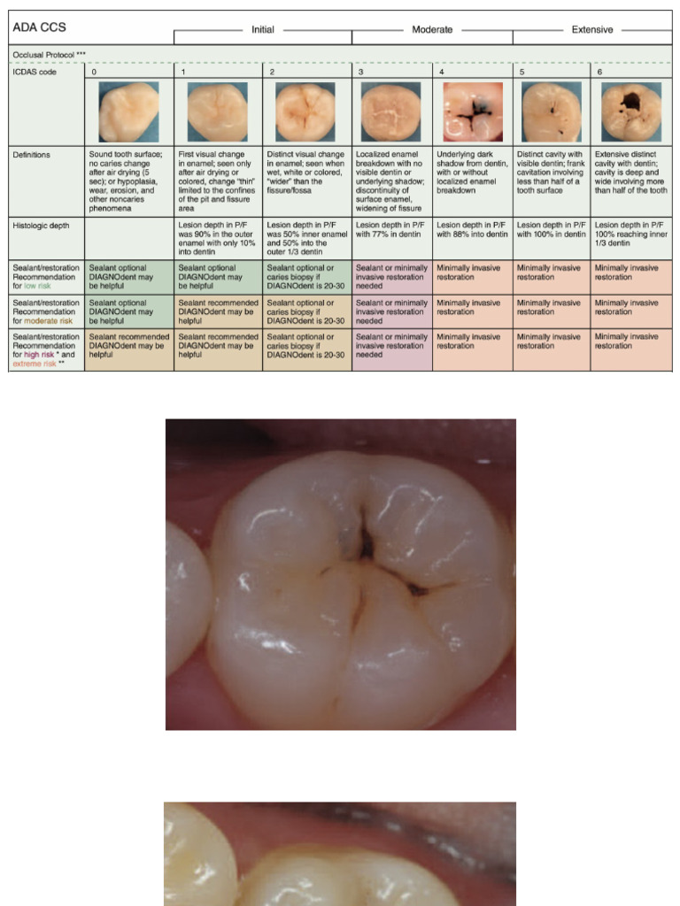 ICDAS | PDF
