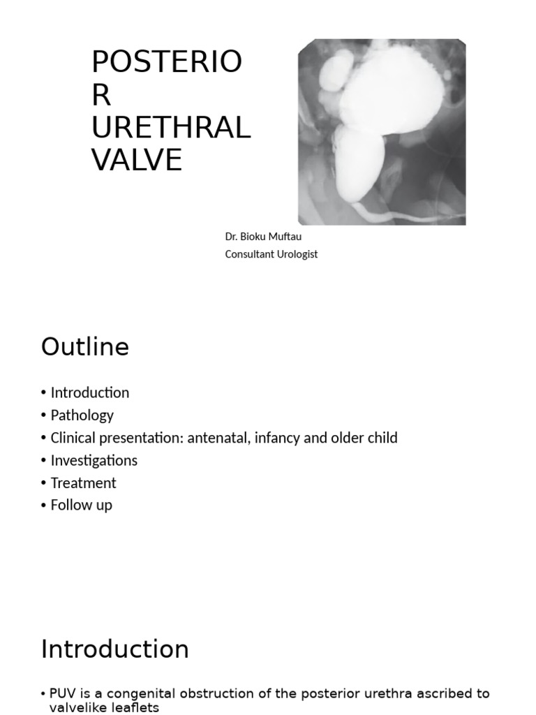 Posterior Urethral Valve Overview | PDF | Urology | Genitourinary System