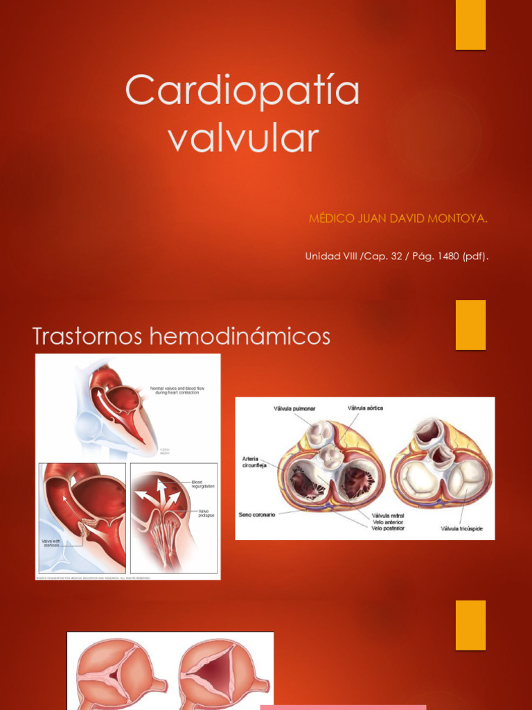 Cardiopatía Valvular: Diagnóstico y Tratamiento | PDF