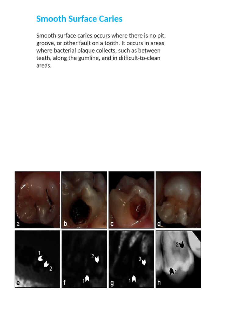 Smooth Surface Caries | PDF