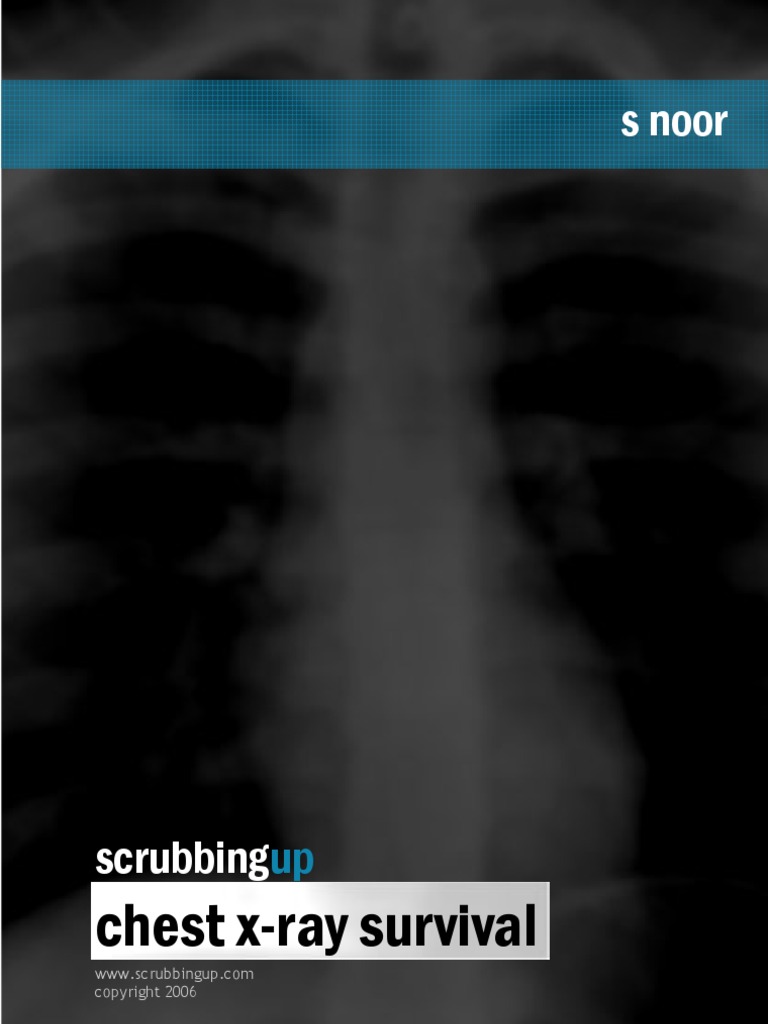 CXR Handbook | PDF | Lung | Pneumonia