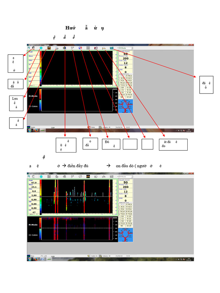 HDSD TCD Edan | PDF