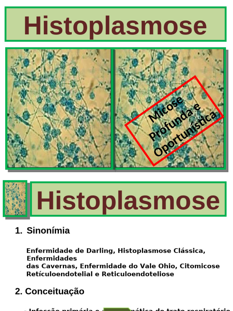 Histoplasmose: Causas, Sintomas e Diagnóstico | PDF | Doenças e ...
