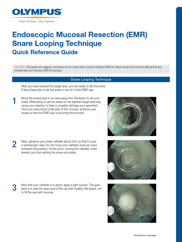 EMR Snare Looping Technique Guide | PDF | Clinical Medicine | Medical ...