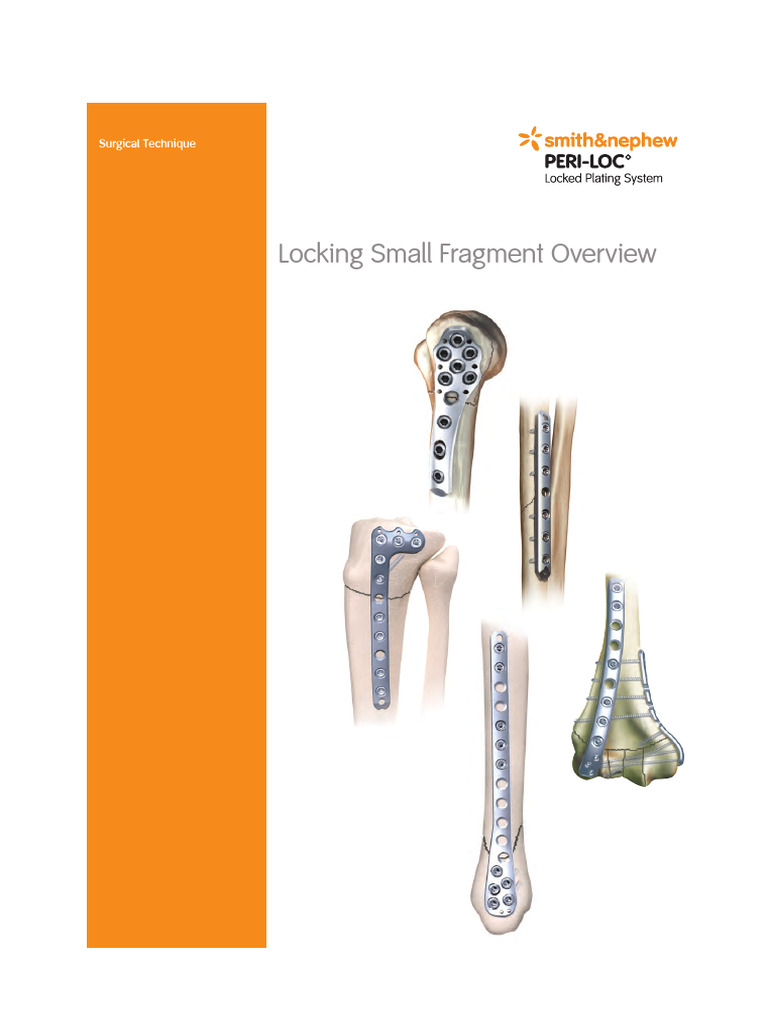 PERI-LOC Small Fragment Surgical Guide | PDF | Screw | Drill