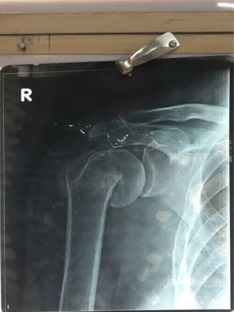 Dagger Sign in Ankylosing Spondylitis | PDF | Skeletal System ...