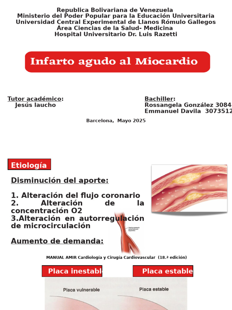 Infarto Agudo al Miocardio: Etiología y Manejo | PDF | Isquemia ...