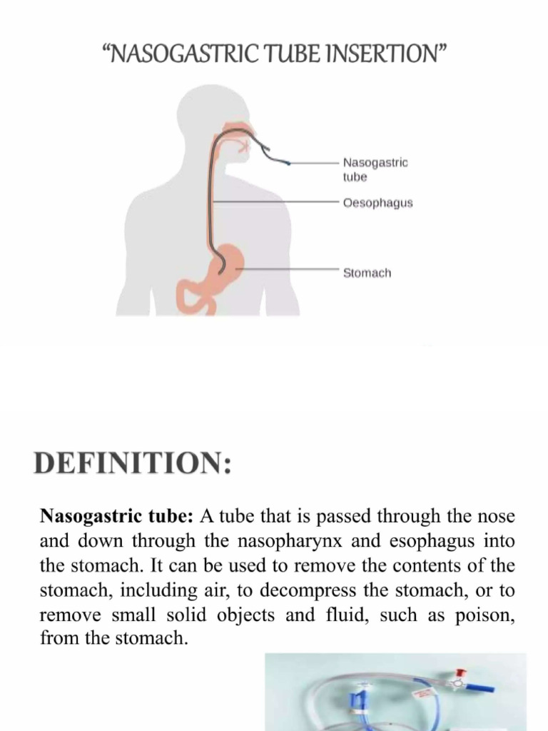 NGT | PDF