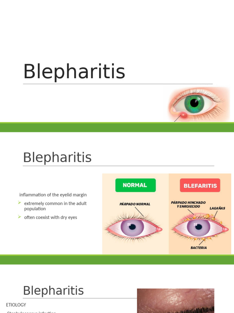 Understanding Blepharitis and Its Management | PDF