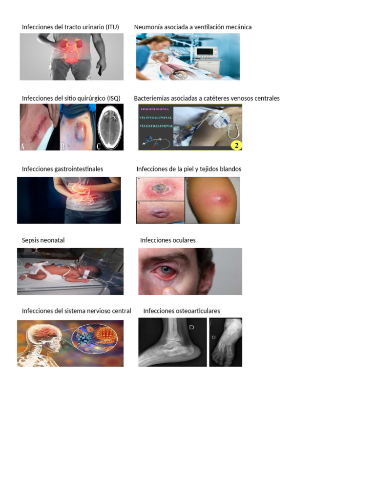 Tipos de Infecciones Comunes Médicas | PDF