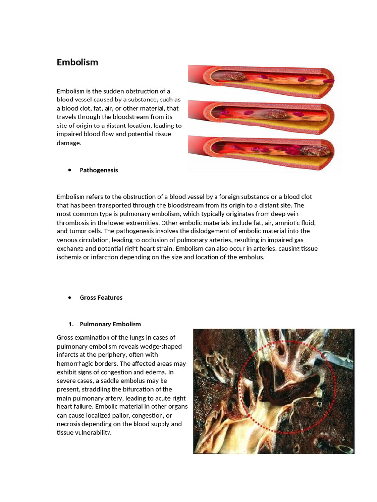 Understanding Embolism: Causes & Effects | PDF