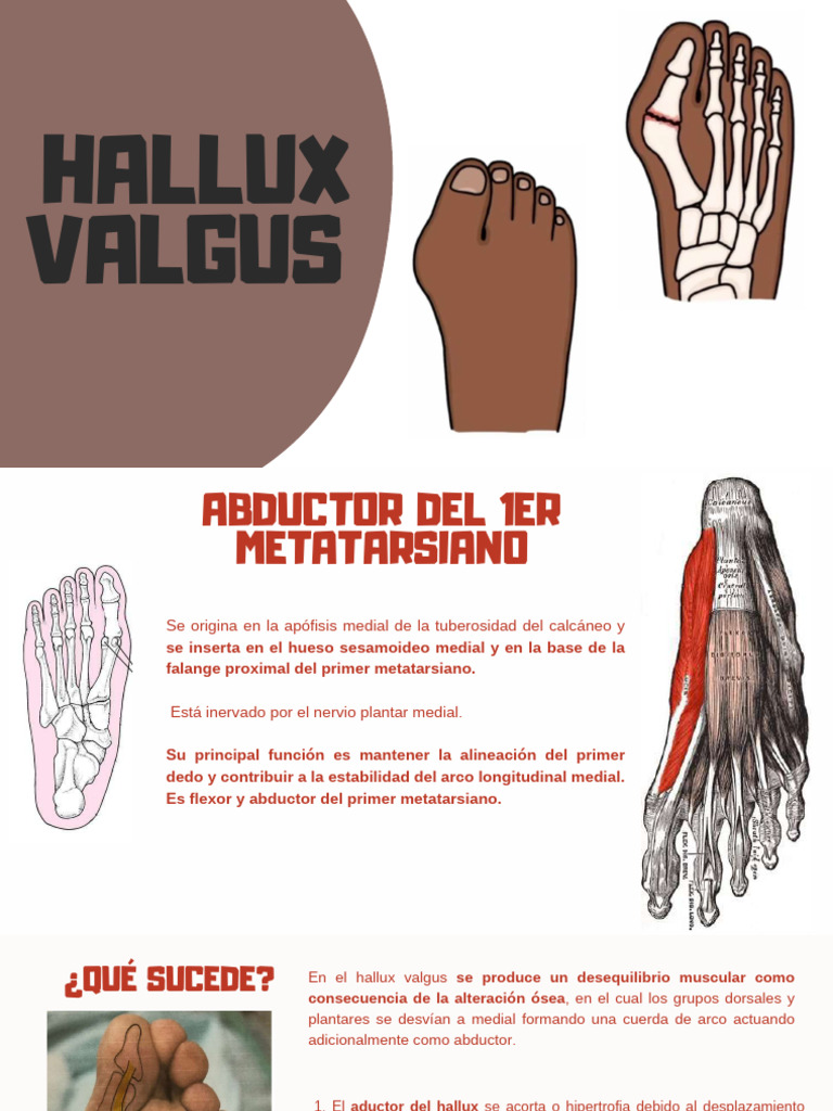 Aductor y abductor del hallux en valgus | PDF