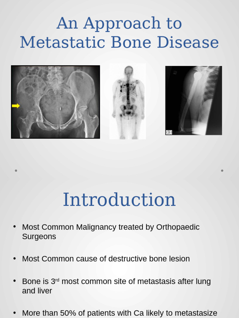Share Metastatic Bone Disease | PDF | Metastasis | Radiation Therapy
