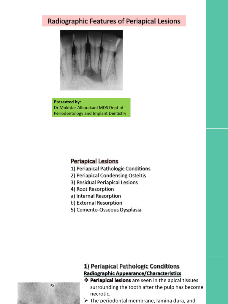 Periapical Lesions: Radiographic Insights | PDF | Dental Anatomy ...
