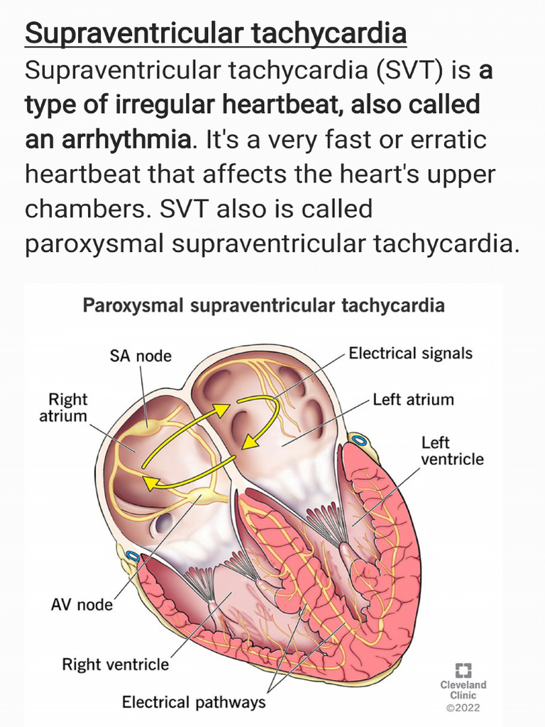 SVT | PDF