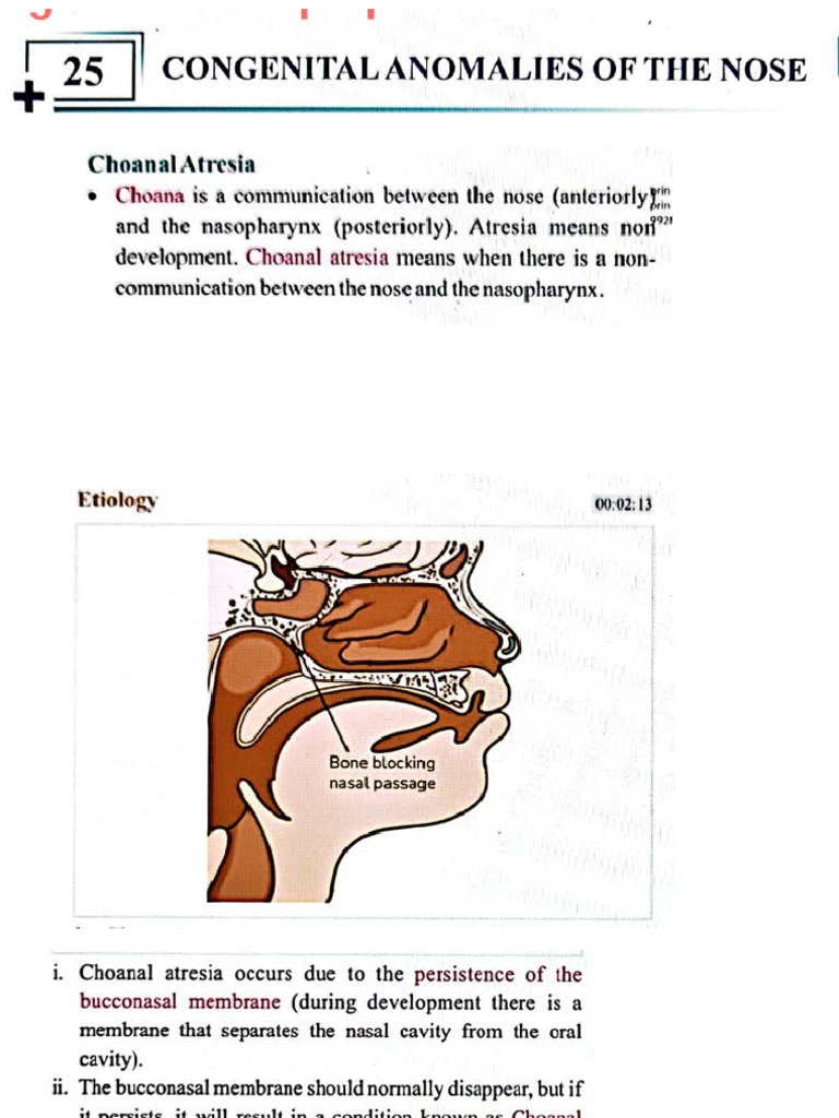Choanal Atresia | PDF