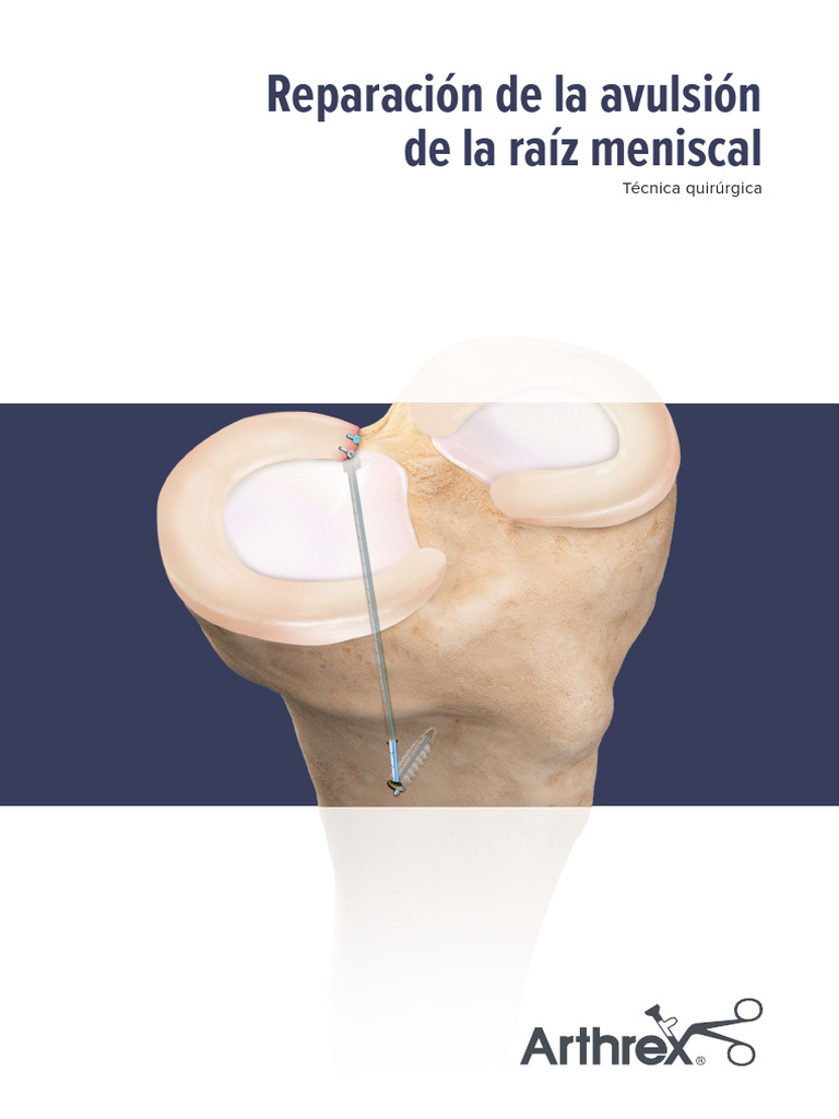 Reparación de La Avulsión de La Raíz Meniscal | PDF | Rodilla ...