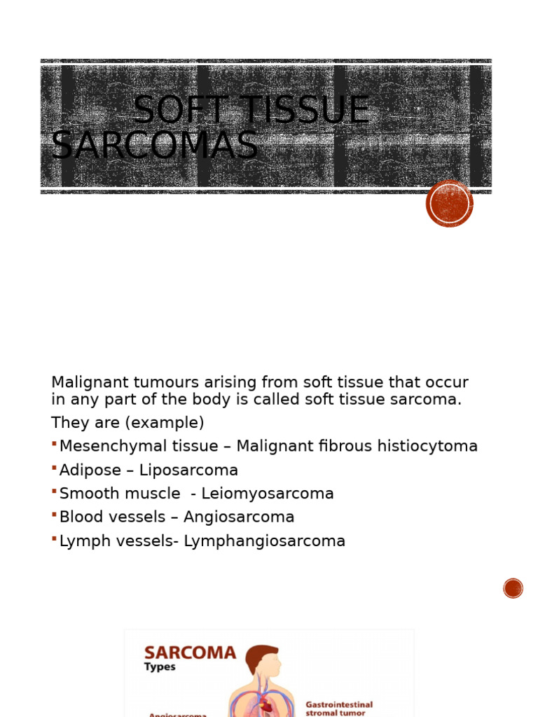 Understanding Soft Tissue Sarcomas | PDF
