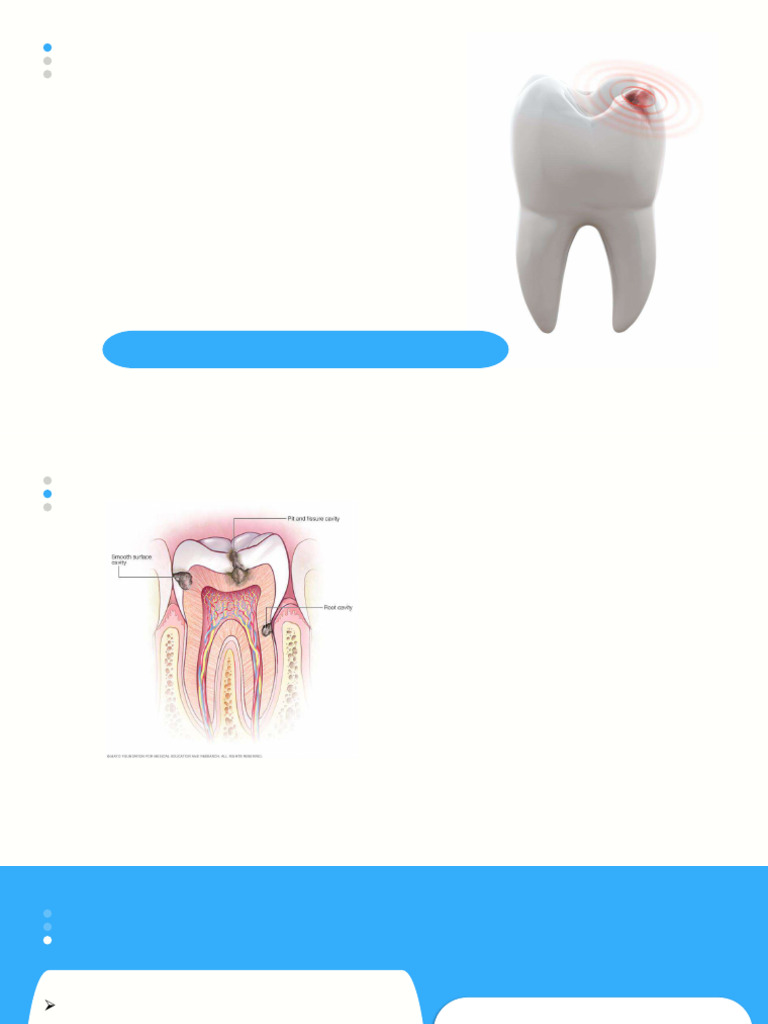 Understanding Dental Caries: Causes & Features | PDF | Human Tooth ...