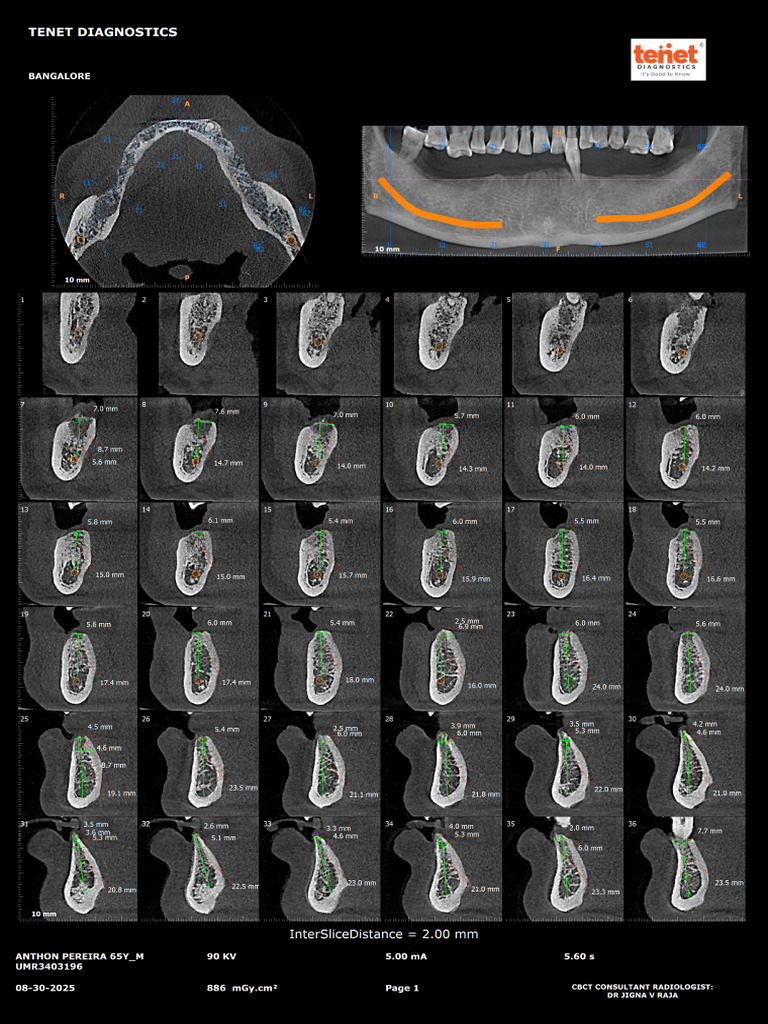 Anthon Pereira 65 Paraxial Sections Mandible | PDF