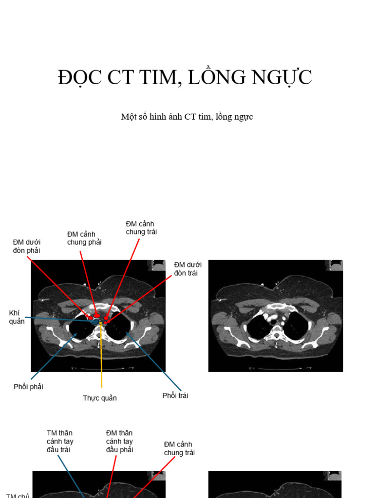 CT Tim-Nguc | PDF