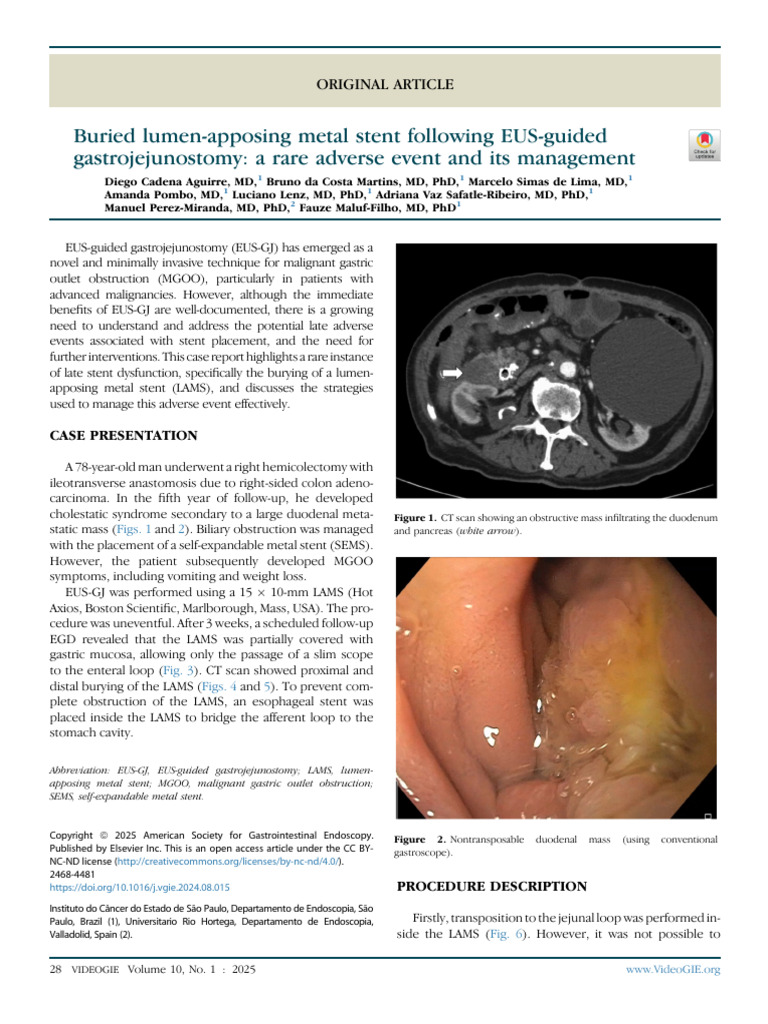 Buried Lumen-Apposing Metal Stent LAMS | PDF | Stent | Clinical Medicine