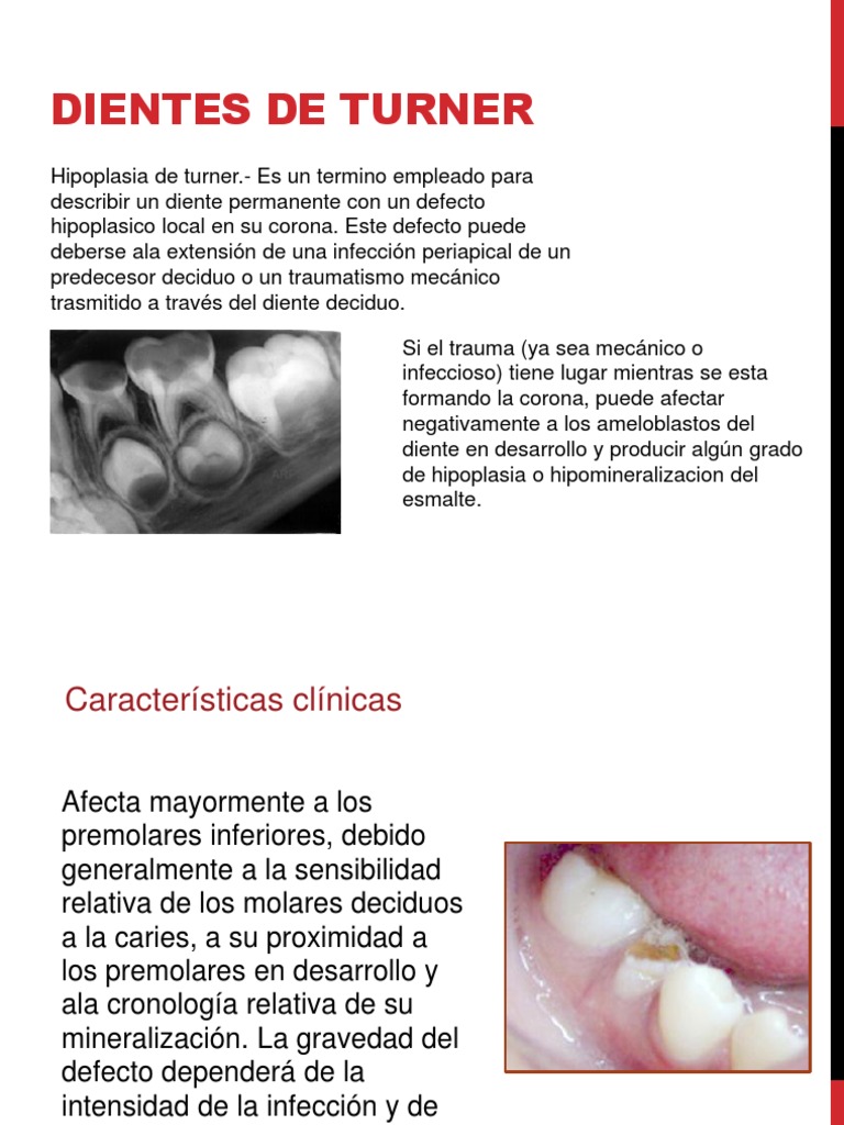 Dientes de Turner Diente humano Enfermedades y trastornos
