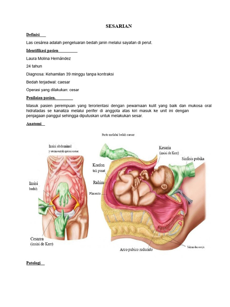 Prosedur Bedah Caesar: Panduan Lengkap | PDF