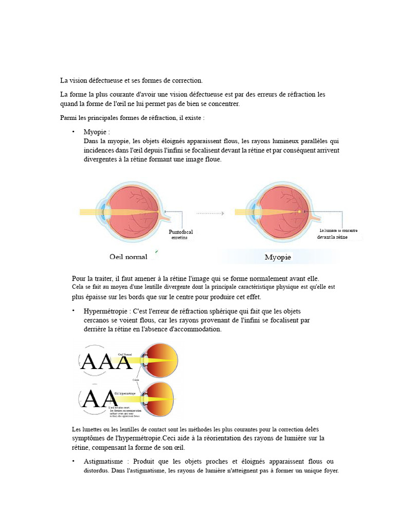 Vision défectueuse : types et corrections | PDF | Myopie | Œil humain