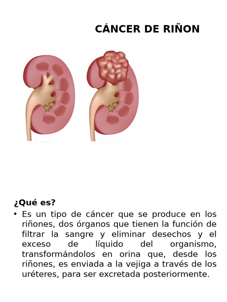 Cancer de Riñon | PDF | Cáncer | Riñón