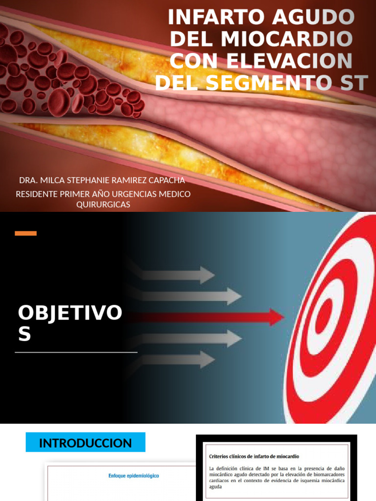 Infarto Agudo de Miocardio: Diagnóstico y Tratamiento | PDF | Infarto ...