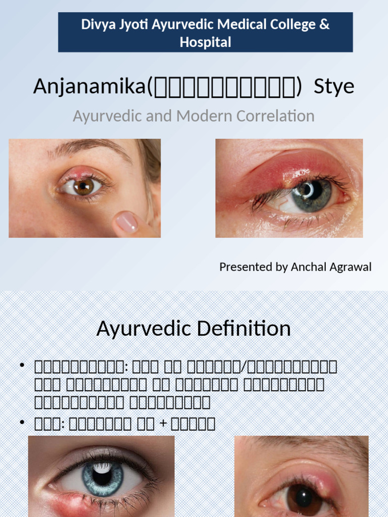 Aanjananamika Vs Stye PPT | PDF