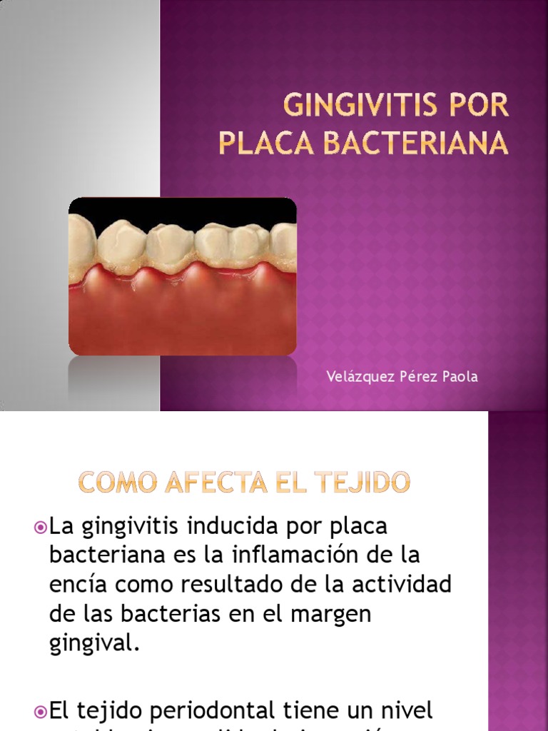 Gingivitis