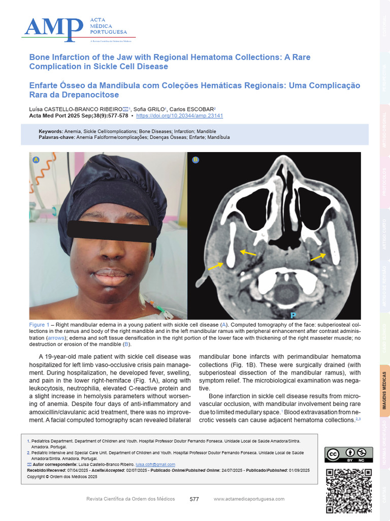 Jaw Bone Infarction in Sickle Cell Disease | PDF | Clinical Medicine ...