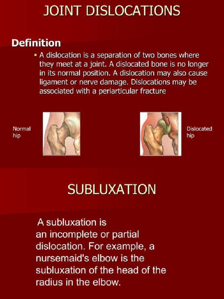 Subluxation and Dislocation | PDF