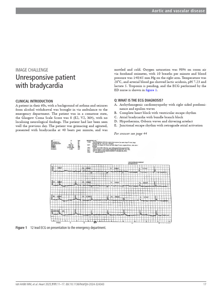 Caso Clinico Hipotermia Com Ondas de Osborn Heart Dez 2024 | PDF ...