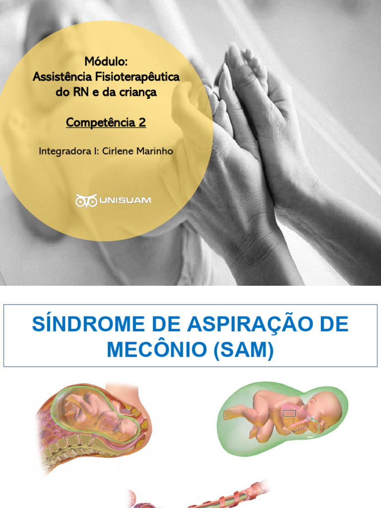 Síndrome de Aspiração de Mecônio: Definição e Tratamento | PDF
