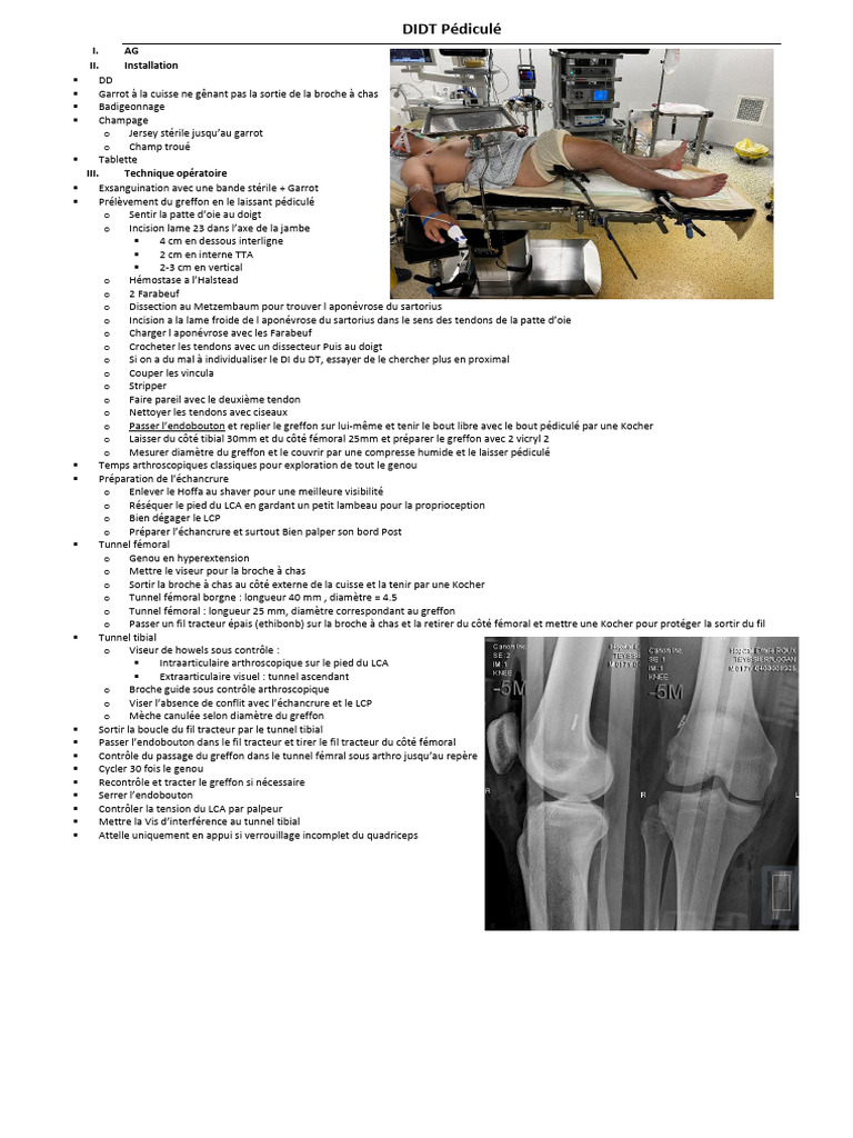 Ligamentoplastie DIDT : Guide Opératoire | PDF | Genou | Articulation ...