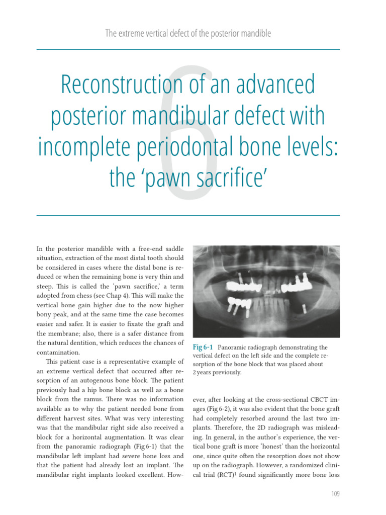 Reconstruction of Severe Mandibular Defect | PDF | Dental Implant | Bone
