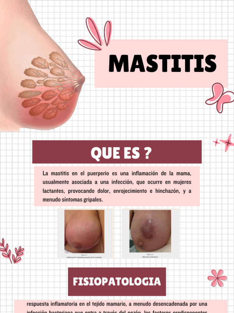 Mastitis en Lactancia: Causas y Tratamiento | PDF | Pecho | Amamantamiento