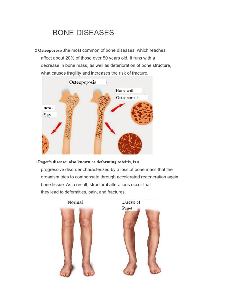 Overview of Bone Diseases | PDF | Bone | Osteoporosis
